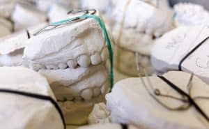 Comment recoller une couronne dentaire avec du dentifrice : guide pratique